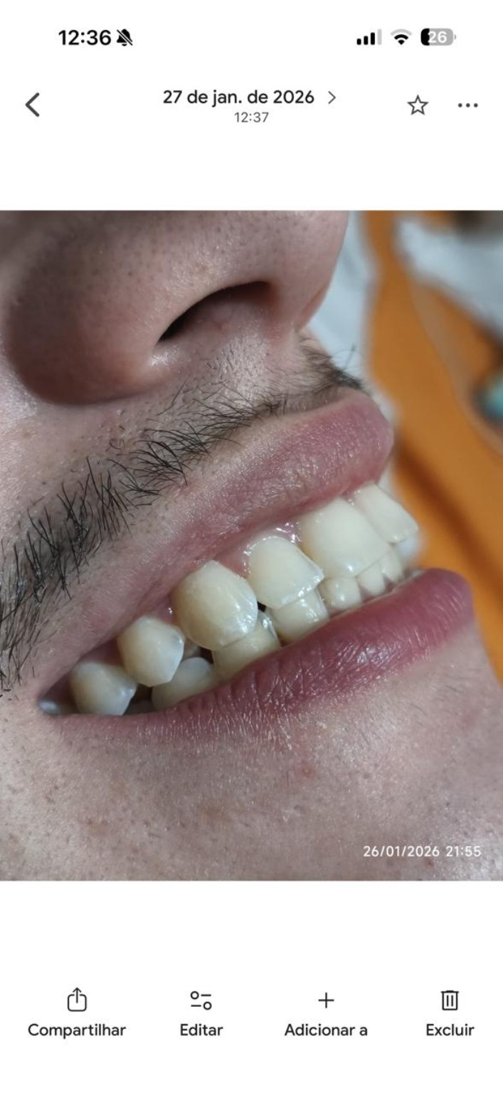 Antes do clareamento dental
