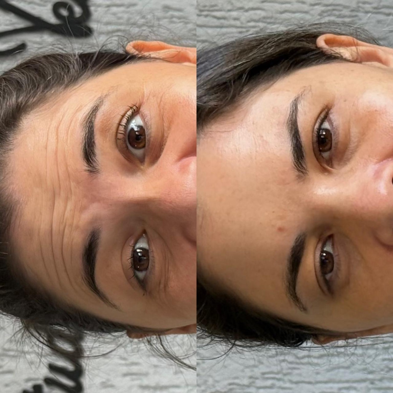 Depois da harmonização facial