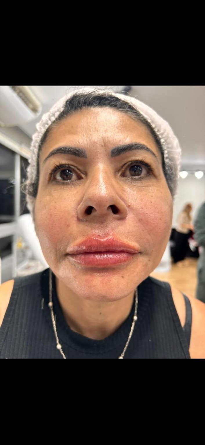Antes do preenchimento labial