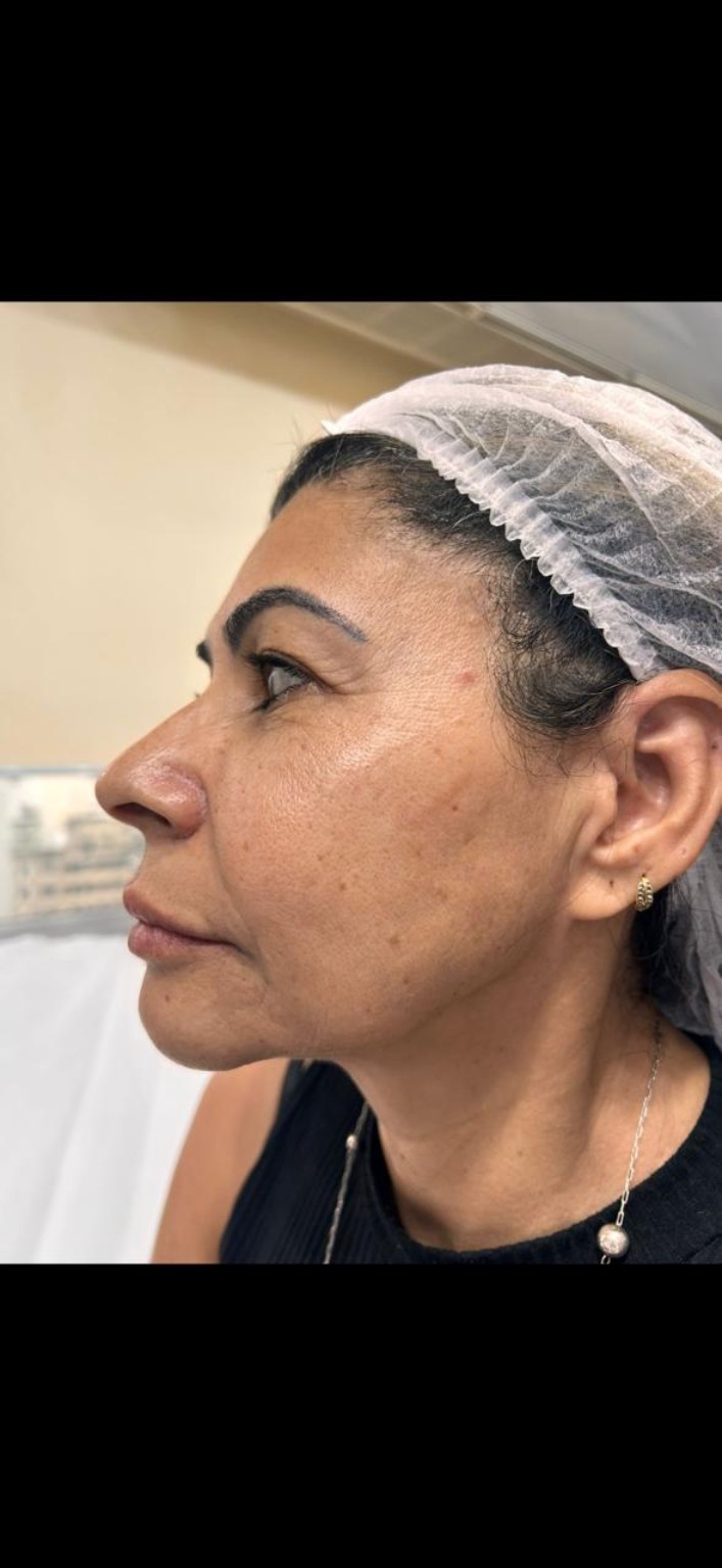 Depois do preenchimento labial