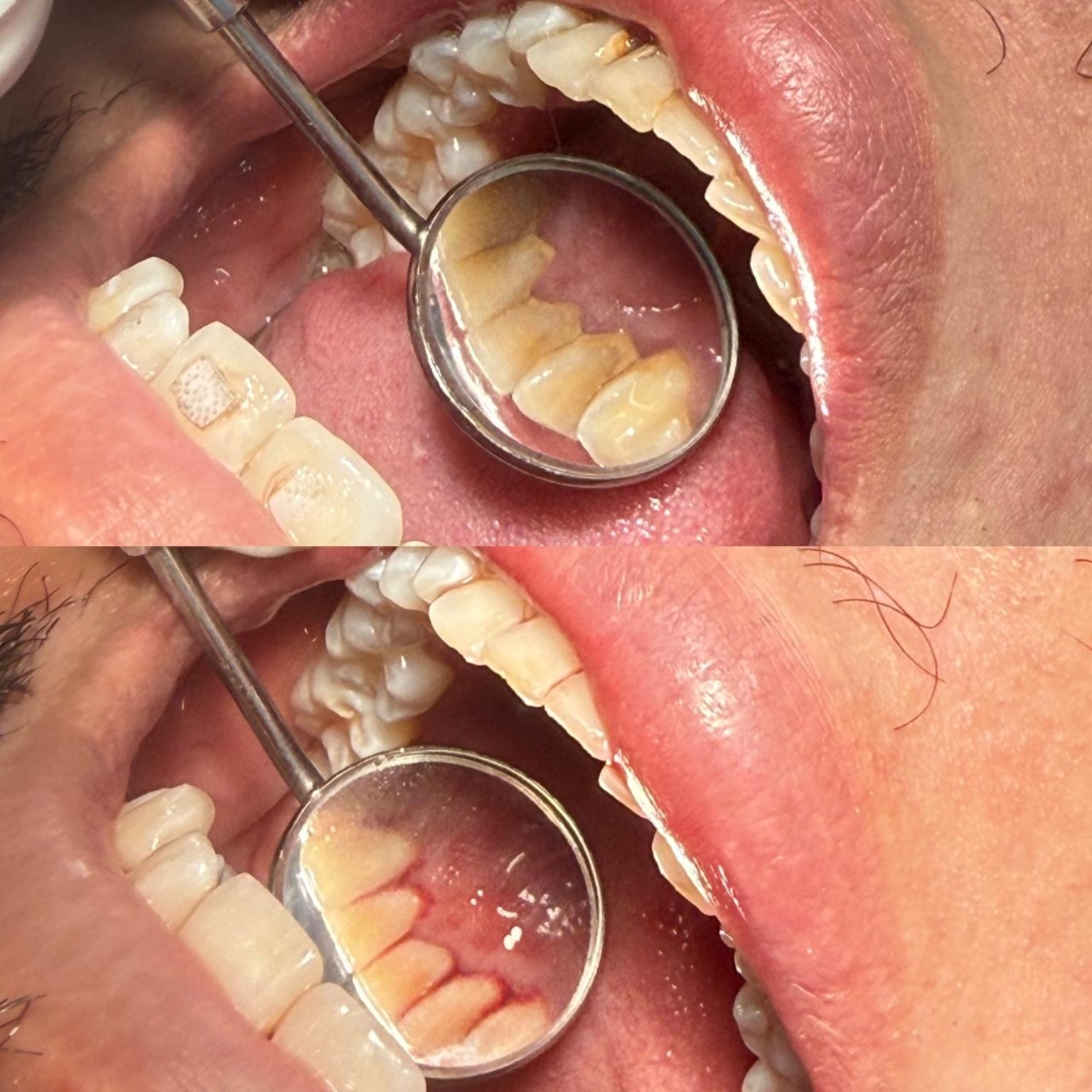 Antes da restauração estética