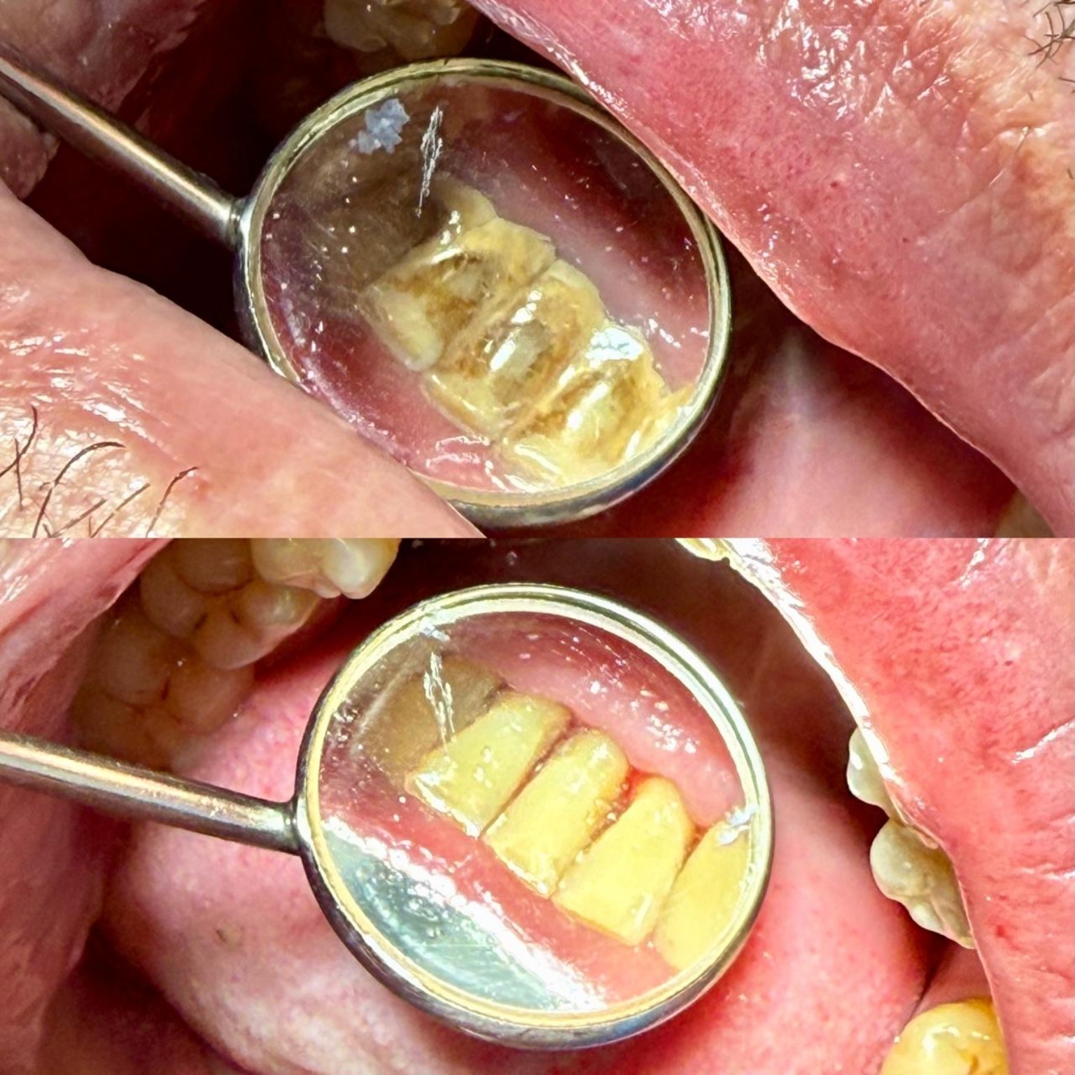 Antes do tratamento estético do sorriso