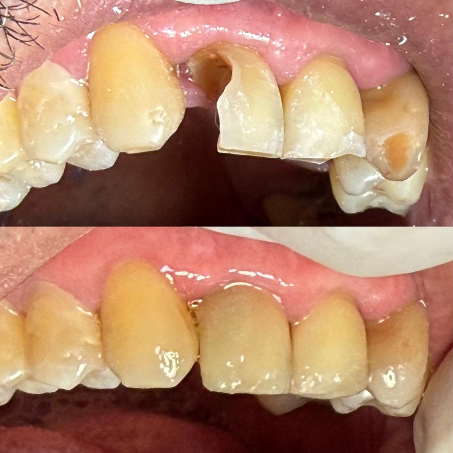 Antes da restauração em dentes posteriores