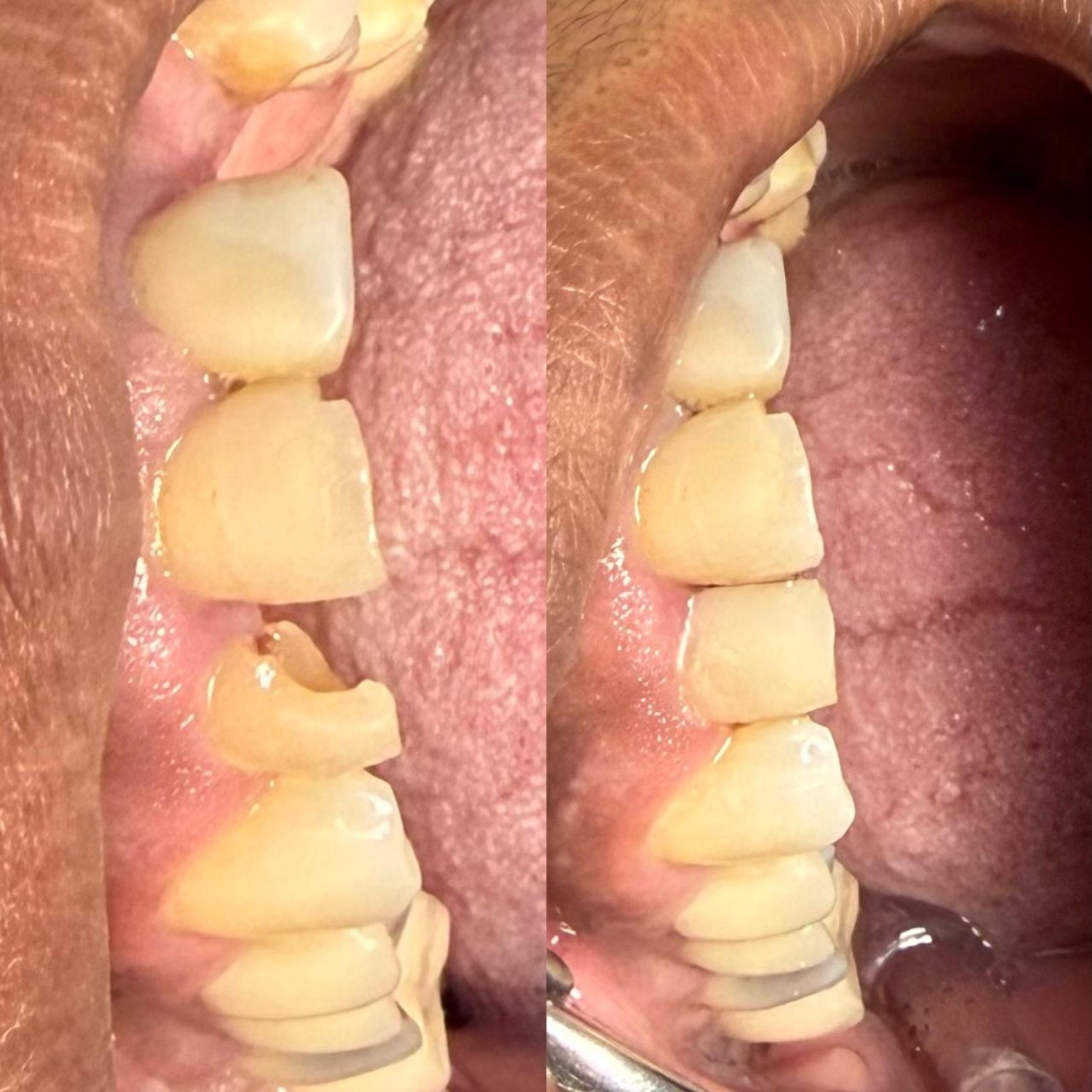 Depois da restauração em dentes posteriores